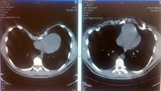 olivier richters x-ray pectus excavatum